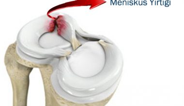 Menisküs Yaralanmaları Nedir